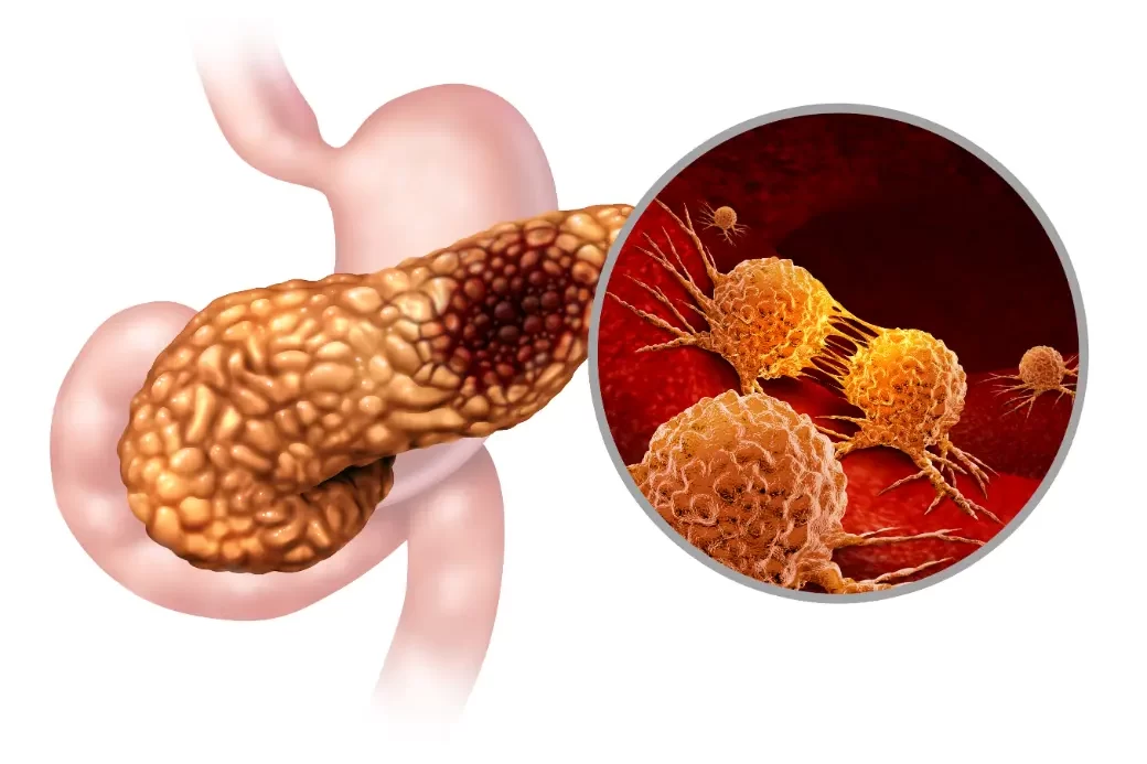 سرطان البنكرياس: أعراض خفية يجب الانتباه إليها